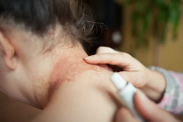 Eczema treatment San Francisco CA