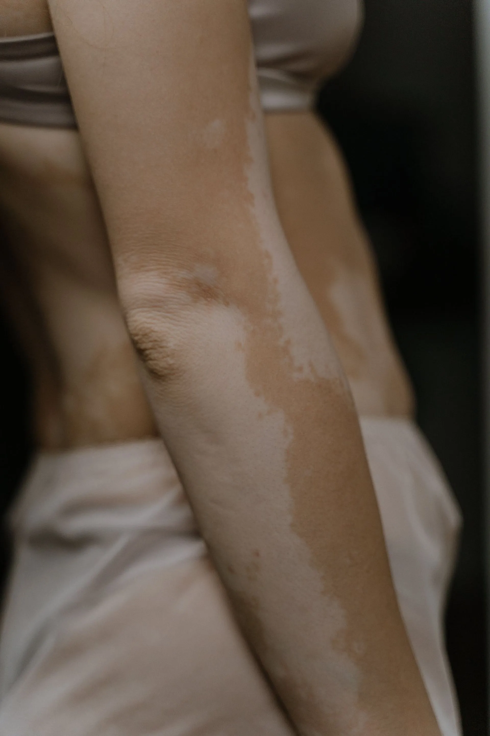 HYPOPIGMENTATION
Reduced melanin production, resulting in lighter areas of skin compared to the surrounding skin