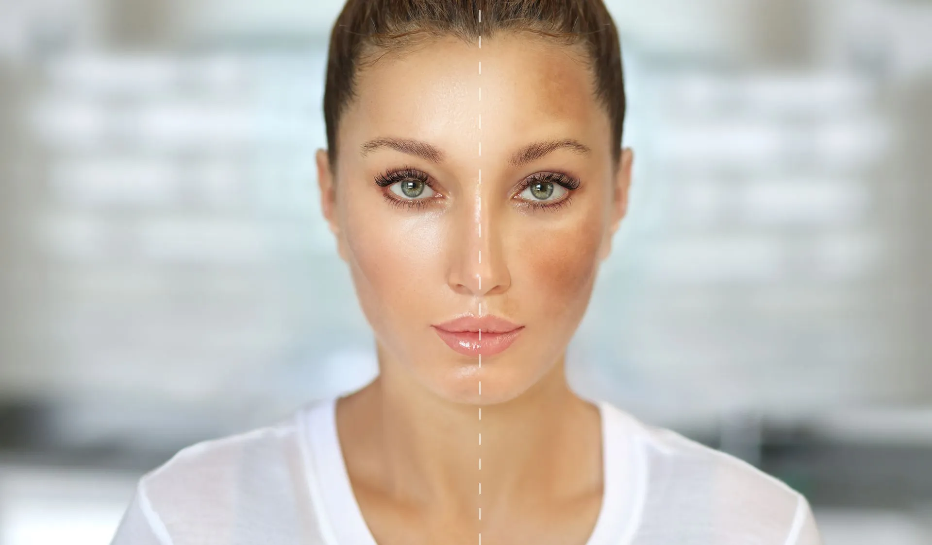 melasma pigmentation