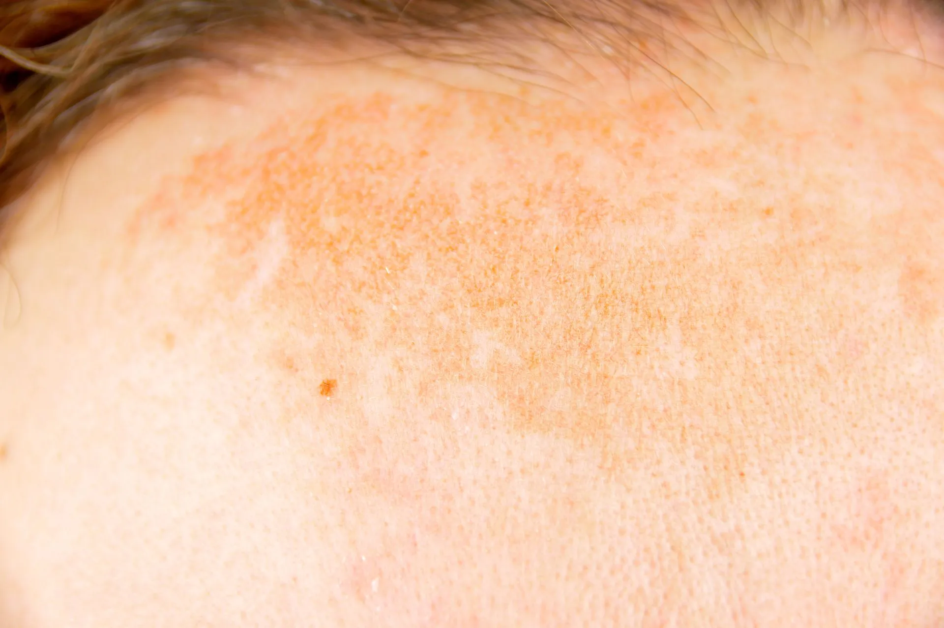 melasma treatment in San Francisco