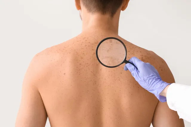 Skin cancer treatment in San Francisco CA