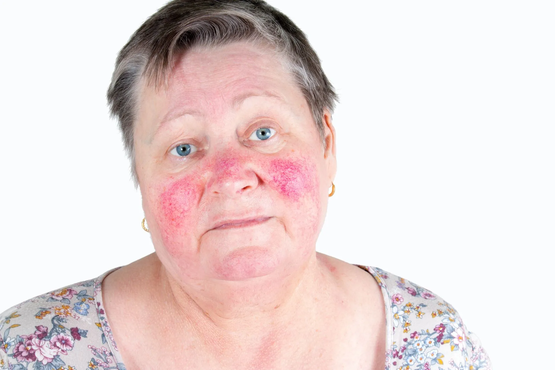 A woman with red spots on her face is looking at the camera.