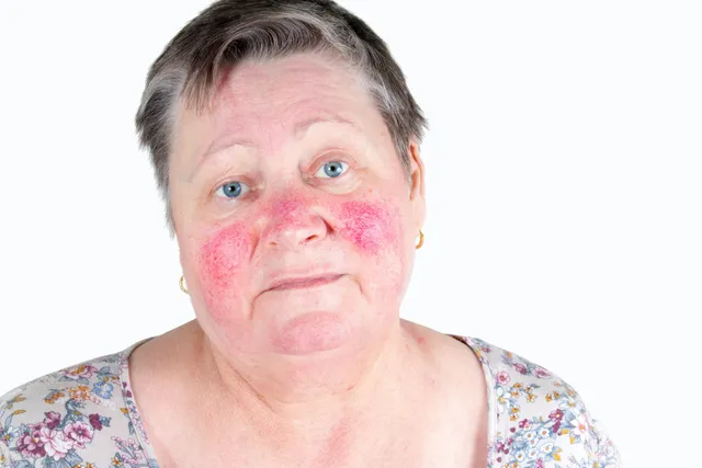 A woman with red spots on her face is looking at the camera.